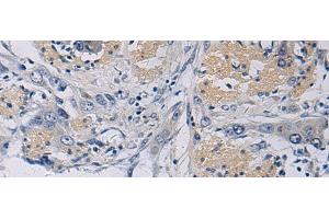 Immunohistochemistry of paraffin-embedded Human esophagus cancer tissue using KLF1 Polyclonal Antibody at dilution of 1:35(x200) (KLF1 抗体)