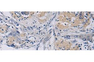 Immunohistochemistry of paraffin-embedded Human esophagus cancer tissue using KLF1 Polyclonal Antibody at dilution of 1:35(x200) (KLF1 抗体)
