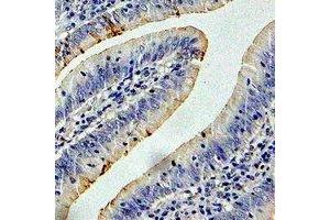 Immunohistochemical analysis of CCT3 staining in human colon cancer formalin fixed paraffin embedded tissue section. (CCT3 抗体)
