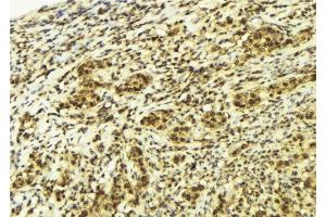 ABIN6277988 at 1/100 staining Human breast cancer tissue by IHC-P. (CTNNBL1 抗体  (N-Term))