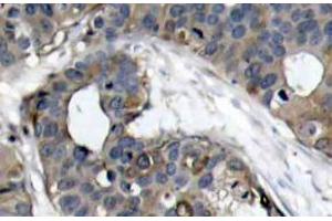 Immunohistochemistry (IHC) analyzes of HSP27 antibody in paraffin-embedded human breast carcinoma tissue. (HSP27 抗体)