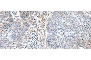 Immunohistochemistry of paraffin-embedded Human lung cancer tissue using WFDC5 Polyclonal Antibody at dilution of 1:60(x200) (WFDC5 抗体)