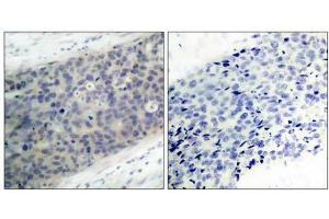 Immunohistochemical analysis of paraffin- embedded human breast carcinoma tissue using LIMK2 (phospho-Thr505) antibody (E011127). (LIMK2 抗体  (pThr505))