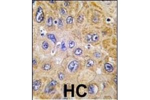 Formalin-fixed and paraffin-embedded human hepatocarcinoma tissue reacted with THY1 antibody (N-term) (ABIN388803 and ABIN2839126) , which was peroxidase-conjugated to the secondary antibody, followed by DAB staining.