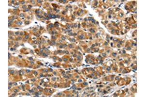 The image on the left is immunohistochemistry of paraffin-embedded Human liver cancer tissue using ABIN7192974(UBAP2 Antibody) at dilution 1/20, on the right is treated with synthetic peptide. (UBAP2 抗体)