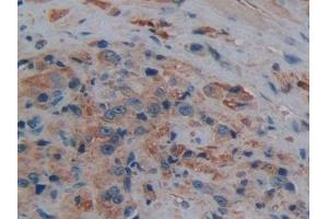 Detection of AQP1 in Human Prostate cancer Tissue using Polyclonal Antibody to Aquaporin 1 (AQP1) (Aquaporin 1 抗体  (AA 201-269))