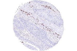 Squamous cell carcinoma containing many IgA positive plasma cells in its stroma (Recombinant 兔 anti-人 IgA Antibody)