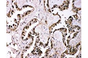 IHC-P: GSTP1 antibody testing of human lung cancer tissue (GSTP1 抗体  (AA 2-210))