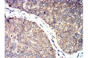 Immunohistochemical analysis of paraffin-embedded ROP1 tissues using bladder cancer mouse mAb with DAB staining. (ROP1 (AA 42-183) 抗体)