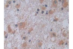 Detection of JAG2 in Human Glioma Tissue using Polyclonal Antibody to Jagged 2 Protein (JAG2) (JAG2 抗体  (AA 714-981))