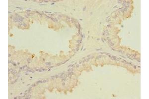 Immunohistochemistry of paraffin-embedded human prostate cancer using ABIN7159008 at dilution of 1:100 (MARCKSL1 抗体  (AA 1-195))