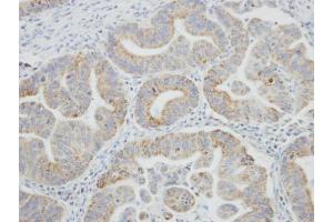 IHC-P Image Immunohistochemical analysis of paraffin-embedded human gastric cancer, using SRPR, antibody at 1:100 dilution. (SRPR 抗体  (Center))