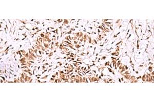 Immunohistochemistry of paraffin-embedded Human ovarian cancer tissue using ISY1-RAB43 Polyclonal Antibody at dilution of 1:55(x200) (ISY1-RAB43 Readthrough (ISY1-RAB43) 抗体)
