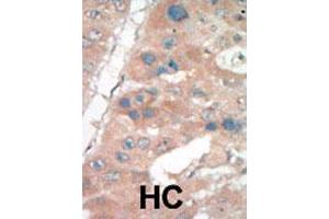 Formalin-fixed and paraffin-embedded human hepatocellular carcinoma tissue reacted with CDKN1A polyclonal antibody  , which was peroxidase-conjugated to the secondary antibody, followed by DAB staining. (p21 抗体  (C-Term))