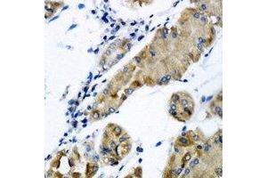 Immunohistochemical analysis of CHMP2B staining in human gastric cancer formalin fixed paraffin embedded tissue section. (CHMP2B 抗体)