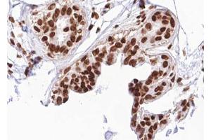 ABIN6267691 at 1/100 staining human breast carcinoma tissue sections by IHC-P. (RACGAP1 抗体  (pSer387))