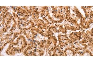 Immunohistochemistry of paraffin-embedded Human thyroid cancer tissue using HEXIM1 Polyclonal Antibody at dilution 1:65 (HEXIM1 抗体)