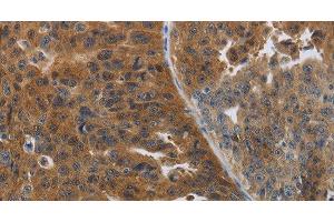 Immunohistochemistry of paraffin-embedded Human ovarian cancer tissue using PDCD2 Polyclonal Antibody at dilution 1:50 (PDCD2 抗体)