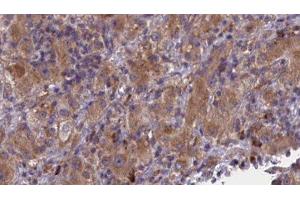 ABIN6277011 at 1/100 staining Human liver cancer tissue by IHC-P. (BMPR1B 抗体  (N-Term))