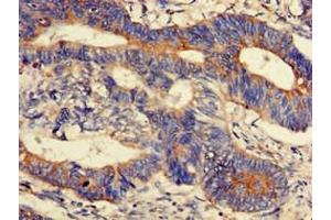 Immunohistochemistry of paraffin-embedded human colon cancer using ABIN7165956 at dilution of 1:100 (PPM1K 抗体  (AA 30-372))