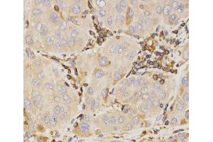 Immunohistochemistry of paraffin-embedded Human liver cancer using KLK5 Polyclonal Antibody at dilution of 1:200 (40x lens). (Kallikrein 5 抗体)