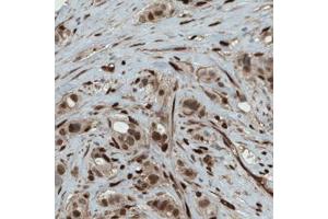 Immunohistochemical staining (Formalin-fixed paraffin-embedded sections) of human breast cancer with WWTR1 monoclonal antibody, clone CL0371  shows strong nuclear and moderate cytoplasmic immunoreactivity in tumor cells. (WWTR1 抗体)