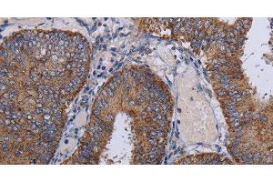 Immunohistochemistry of paraffin-embedded Human colon cancer tissue using NDUFA1 Polyclonal Antibody at dilution 1:30 (NDUFA1 抗体)