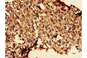 Immunohistochemistry of paraffin-embedded human melanoma using ABIN7154186 at dilution of 1:100 (GLRA1 抗体  (AA 23-113))