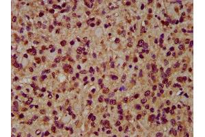 IHC image of ABIN7143995 diluted at 1:200 and staining in paraffin-embedded human glioma performed on a Leica BondTM system. (AIMP1 抗体  (AA 25-180))