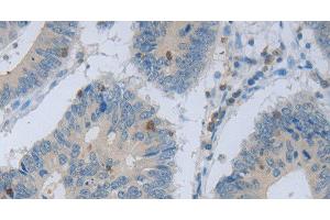 Immunohistochemistry of paraffin-embedded Human colon cancer using MAGEB4 Polyclonal Antibody at dilution of 1:40 (MAGEB4 抗体)