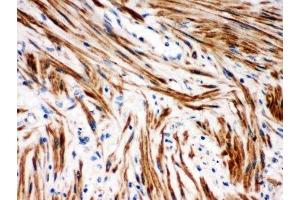 IHC-P: IkB beta antibody testing of human intestinal cancer tissue (NFKBIB 抗体  (AA 56-237))