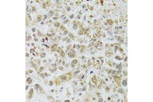 Immunohistochemistry of paraffin-embedded human lung cancer using DMAP1 antibody. (DMAP1 抗体  (AA 1-305))