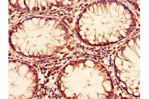 Immunohistochemistry of paraffin-embedded human colon cancer using ABIN7151381 at dilution of 1:100 (ENTPD8 抗体  (AA 30-434))