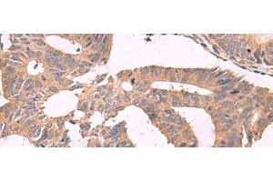 Immunohistochemistry of paraffin-embedded Human colorectal cancer tissue using MGP Polyclonal Antibody at dilution of 1:75(x200) (MGP 抗体)