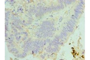 Immunohistochemistry of paraffin-embedded human colon cancer using ABIN7160089 at dilution of 1:100 (MAD2L1 抗体  (AA 1-205))