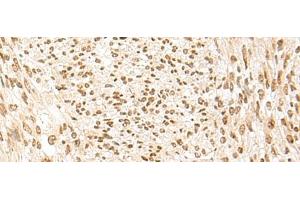 Immunohistochemistry of paraffin-embedded Human liver cancer tissue using POM121 Polyclonal Antibody at dilution of 1:75(x200) (POM121 抗体)