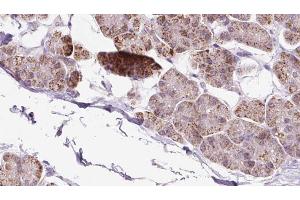 ABIN6273241 at 1/100 staining Human pancreas cancer tissue by IHC-P. (EXOC5 抗体  (Internal Region))