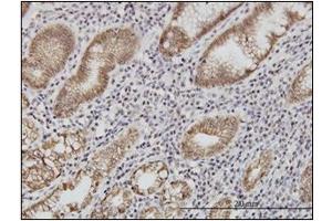 Immunohistochemistry (IHC) image for anti-Cadherin 1, Type 1, E-Cadherin (Epithelial) (CDH1) (AA 381-481) antibody (ABIN614587) (E-cadherin 抗体  (AA 381-481))