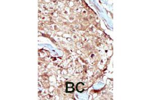 Formalin-fixed and paraffin-embedded human cancer tissue reacted with PAPSS2 polyclonal antibody  , which was peroxidase-conjugated to the secondary antibody, followed by AEC staining. (PAPSS2 抗体  (C-Term))