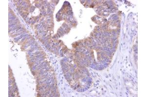 IHC-P Image GPR82 antibody [N2C1], Internal detects GPR82 protein at cytosol on human colon carcinoma by immunohistochemical analysis. (GPR82 抗体)