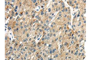 The image on the left is immunohistochemistry of paraffin-embedded Human liver cancer tissue using ABIN7190275(CLDN19 Antibody) at dilution 1/35, on the right is treated with synthetic peptide. (Claudin 19 抗体)