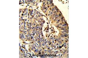 Formalin-fixed and paraffin-embedded human Lung carcinoma reacted with C21orf29 Antibody (Center), which was peroxidase-conjugated to the secondary antibody, followed by DAB staining. (TSPEAR 抗体  (Middle Region))