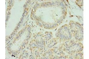 Immunohistochemistry of paraffin-embedded human breast cancer using ABIN7168731 at dilution of 1:100 (SCAMP4 抗体  (AA 170-228))