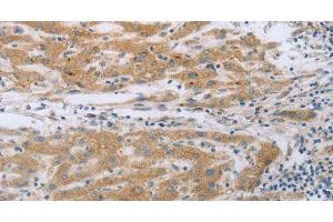 Immunohistochemistry of paraffin-embedded Human liver cancer using TNK2 Polyclonal Antibody at dilution of 1:70 (TNK2 抗体)