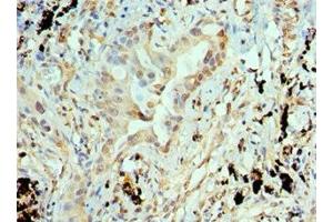 Immunohistochemistry of paraffin-embedded human lung cancer using ABIN7144325 at dilution of 1:100 (ANTXR1 抗体  (AA 315-564))