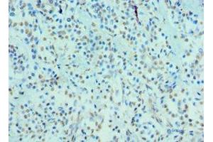 Immunohistochemistry of paraffin-embedded human breast cancer using ABIN7148701 at dilution of 1:100 (CRY2 抗体  (AA 434-593))