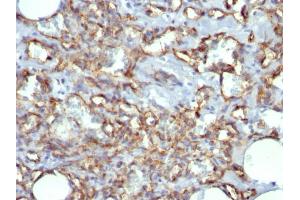 Formalin-fixed, paraffin-embedded human Angiosarcoma stained with CD31 Mouse Monoclonal Antibody (JC/70A)