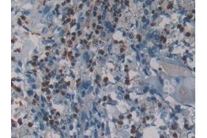 Detection of NE in Human Lung cancer Tissue using Polyclonal Antibody to Neutrophil Elastase (NE) (ELANE 抗体  (AA 30-247))
