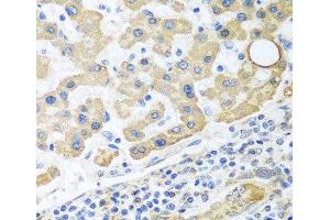 Immunohistochemistry of paraffin-embedded Human liver cancer using GLUD1 Polyclonal Antibody at dilution of 1:100 (40x lens). (GLUD1 抗体)