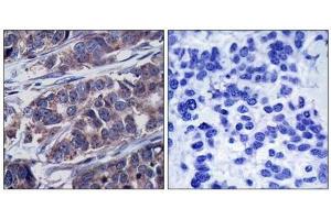 Immunohistochemical analysis of paraffin-embedded human breast carcinoma tissue using p62Dok(Phospho-Tyr362) Antibody(left) or the same antibody preincubated with blocking peptide(right). (DOK1 抗体  (pTyr362))